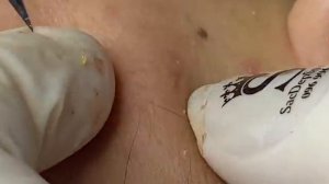 ВЫДАВЛИВАЕТ ПРЫЩИ И УГРИ. СОЧНОЕ РЕЛАКС ВИДЕО