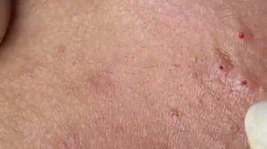 ВЫДАВЛИВАЕТ ПРЫЩИ И УГРИ. СОЧНОЕ РЕЛАКС ВИДЕО