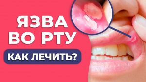 Как вылечить ЯЗВУ ВО РТУ? / Афта: причины появления