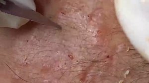 ВЫДАВЛИВАЕТ ПРЫЩИ И УГРИ. СОЧНОЕ РЕЛАКС ВИДЕО