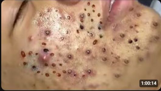 ВЫДАВЛИВАНИЕ ПРЫЩЕЙ ДЛИННОЕ ВИДЕО НОВОЕ (3) смотреть онлайн