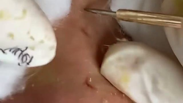 ВЫДАВЛИВАНИЕ ПРЫЩЕЙ ДЛИННОЕ ВИДЕО НОВОЕ (2) смотреть онлайн