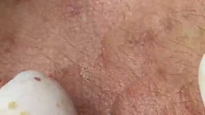 ВЫДАВЛИВАЕТ ПРЫЩИ И УГРИ. СОЧНОЕ РЕЛАКС ВИДЕО