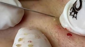ВЫДАВЛИВАЕТ ПРЫЩИ И УГРИ. СОЧНОЕ РЕЛАКС ВИДЕО