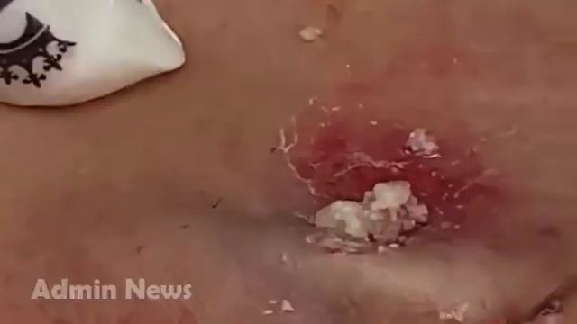 Relax squeezing out blackheads #50 Черные точки смотреть онлайн