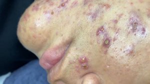 267 • Acne collection • АСМР • Relax Spa