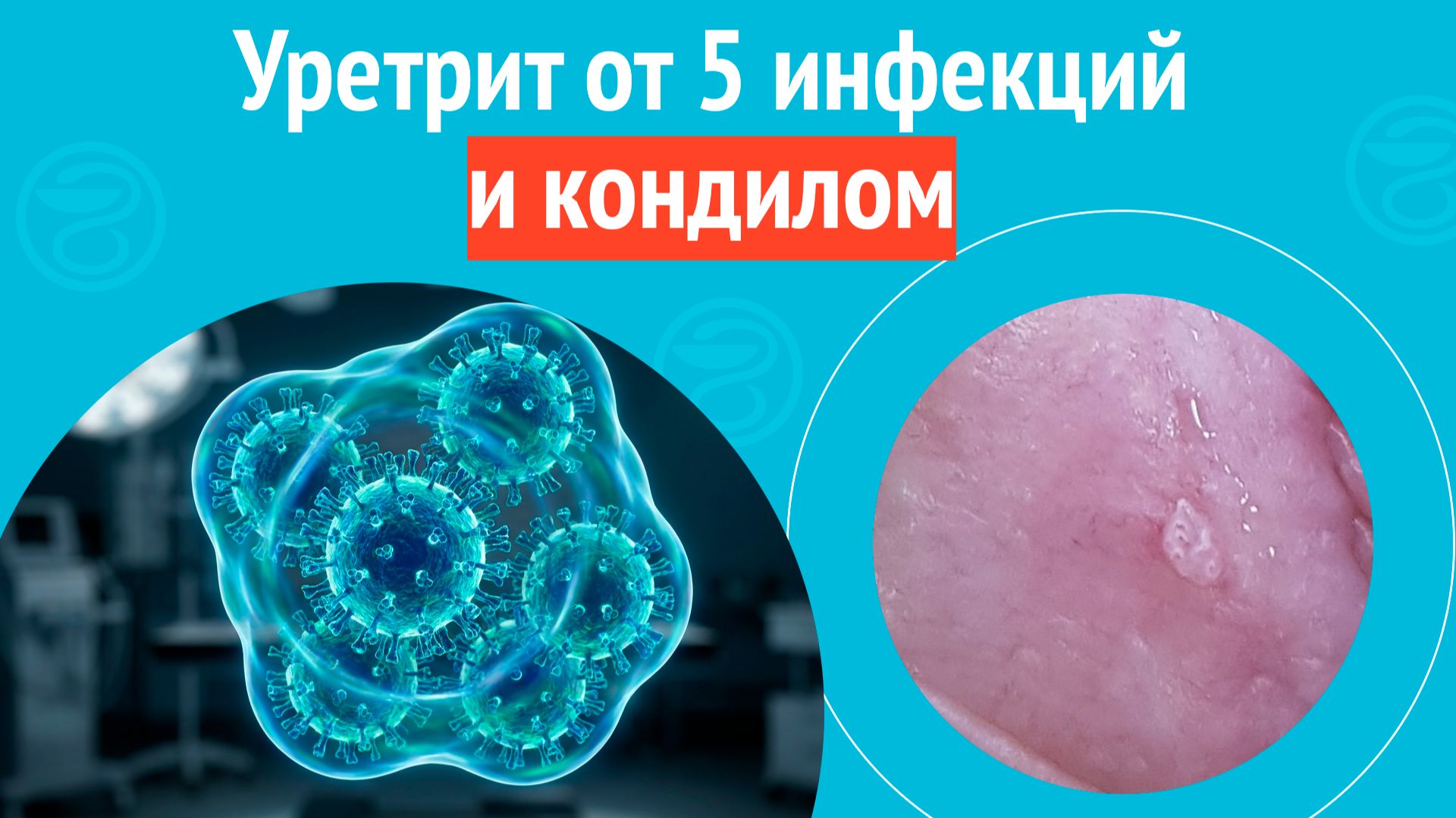 😮 Уретрит от 5 инфекций и кондилом. Клинический случай №1704 смотреть онлайн