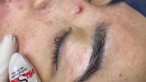 259 • Acne collection • АСМР • Relax Spa