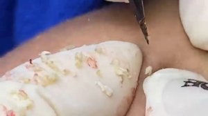 ВЫДАВЛИВАЕТ ПРЫЩИ И УГРИ. СОЧНОЕ РЕЛАКС ВИДЕО