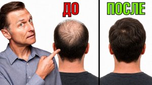 Выпадение волос? Почему средства от облысения НЕ РАБОТАЮТ?