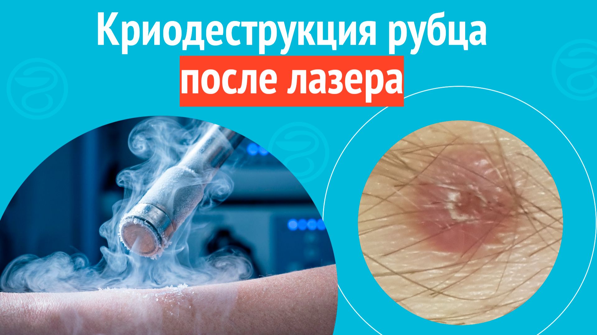 ➡️ Криодеструкция рубца после лазера. Клинический случай №1690 смотреть онлайн