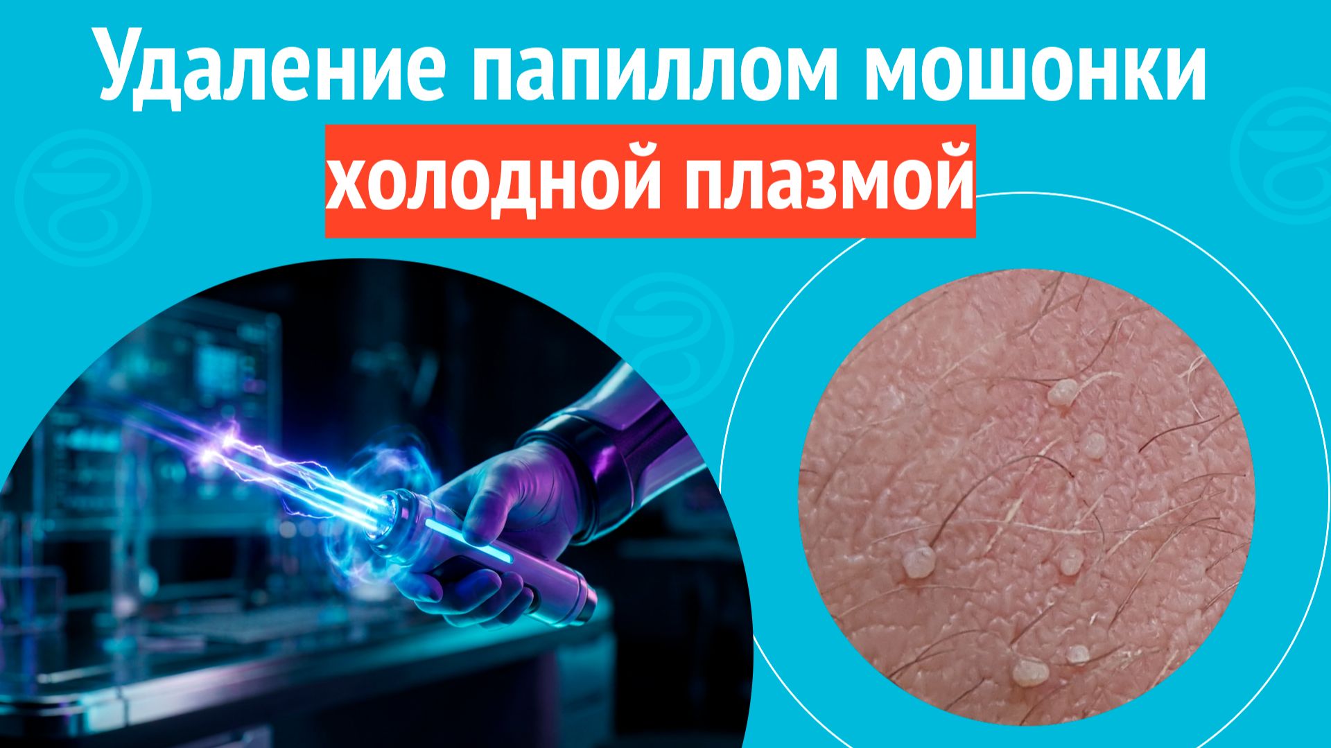 ✅ Удаление папиллом мошонки холодной плазмой. Клинический случай №1682 смотреть онлайн