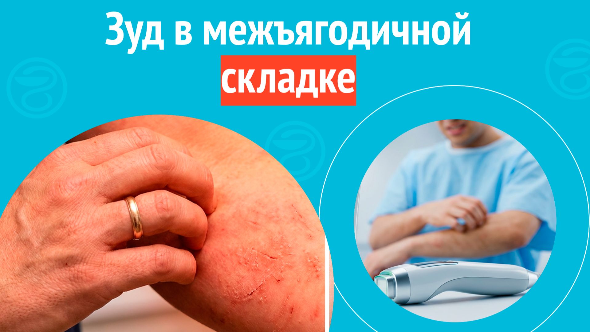➡️ Зуд в межъягодичной складке. Клинический случай №1686 смотреть онлайн