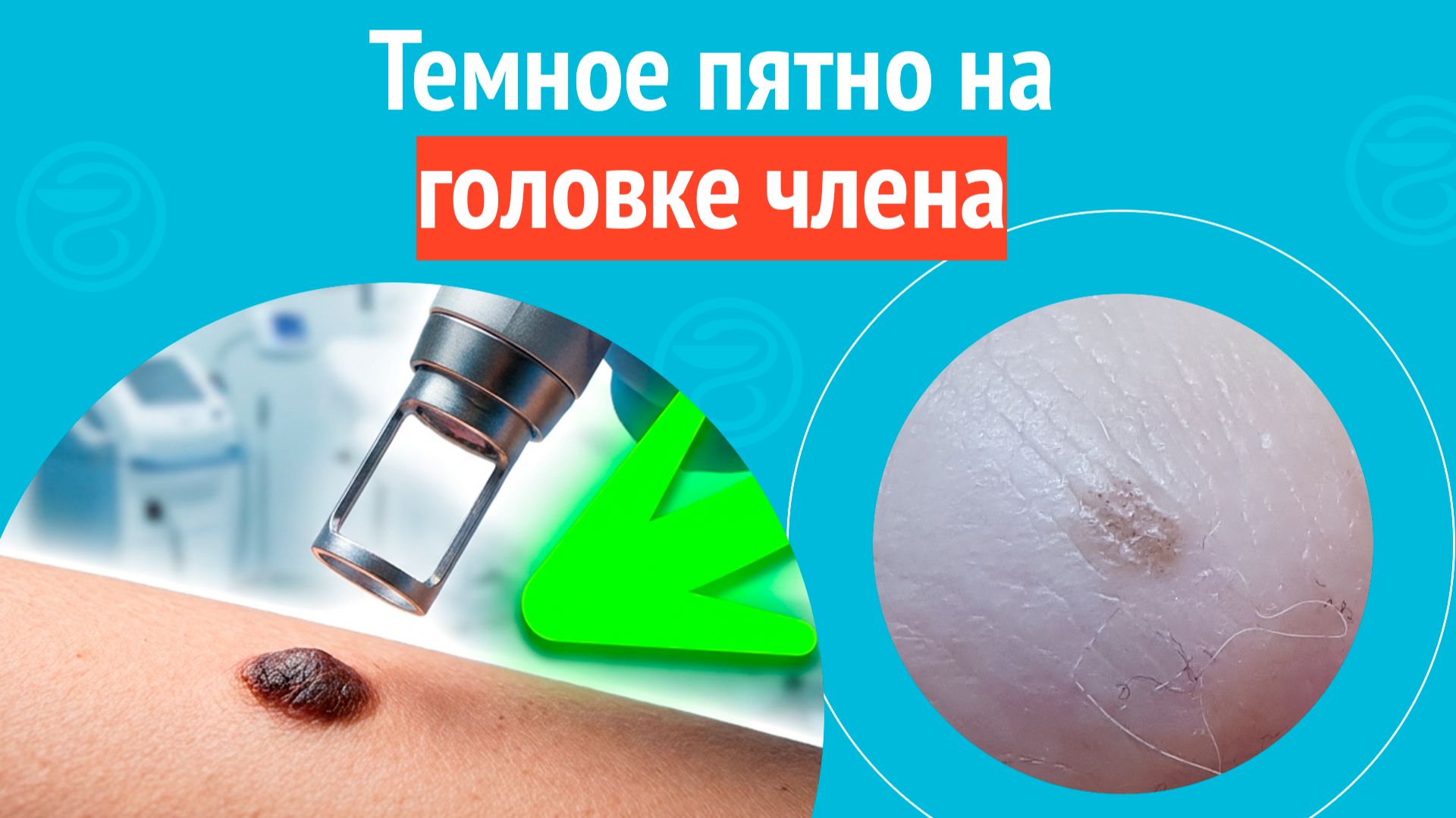 😦 Темное пятно на головке члена. Клинический случай №1687 смотреть онлайн