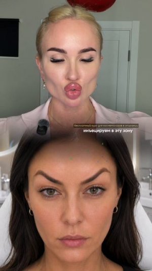 Злой взгляд после ботокса