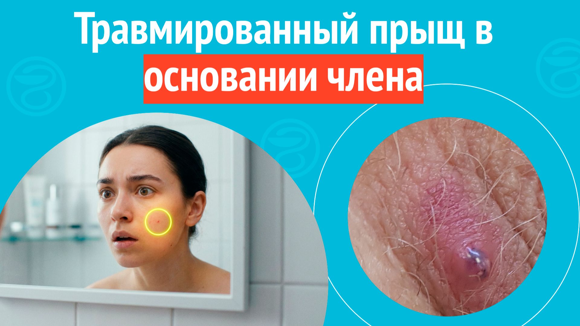 😯 Травмированный прыщ в основании члена. Клинический случай №1688 смотреть онлайн