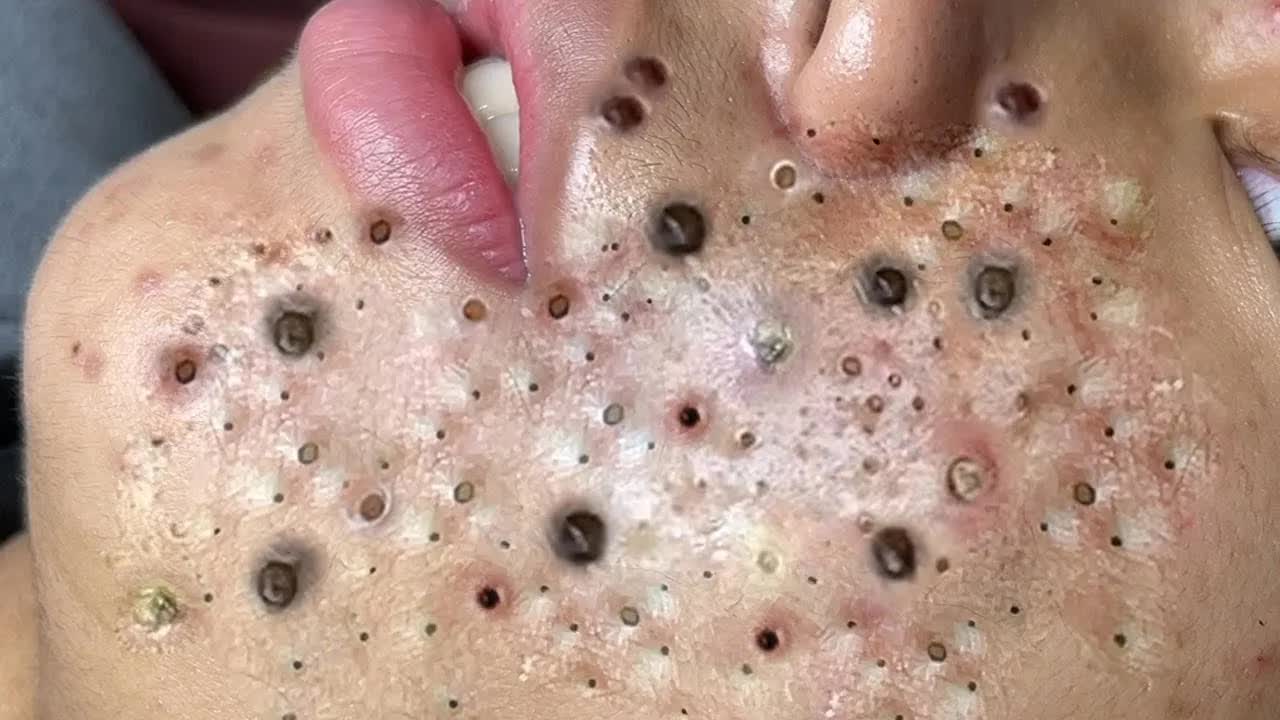 Relaxing Blemish Care And Deep Pore Cleansing #34623