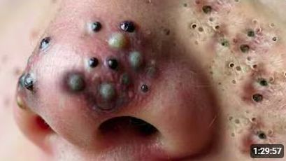 Deep Clean_ Removendo cravos abertos do nariz (blackhead extraction) смотреть онлайн