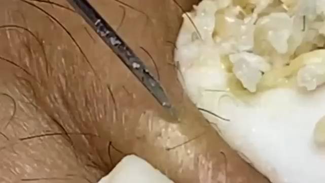 Extreme Blackhead Removal Satisfying Relaxing #975 смотреть онлайн