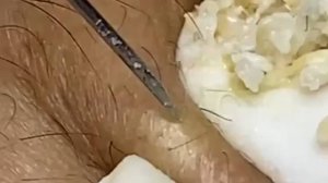 Extreme Blackhead Removal Satisfying Relaxing #975