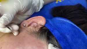Глубокая очистка пор и удаление прыщей