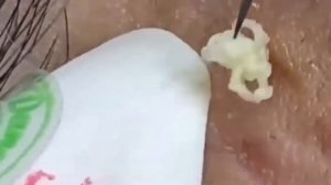 ВЫДАВЛИВАНИЕ ПРЫЩЕЙ И ЧЁРНЫХ ТОЧЕК КОРЕЯ