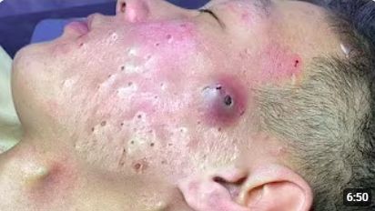 ЧИСТКА НОСА ОТ ЧЁРНЫХ ТОЧЕК — ОЧЕНЬ МНОГО ГРЯЗИ смотреть онлайн
