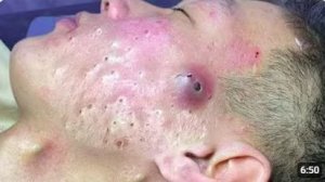 ЧИСТКА НОСА ОТ ЧЁРНЫХ ТОЧЕК — ОЧЕНЬ МНОГО ГРЯЗИ