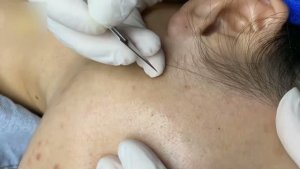 Профессиональное удаление подкожных прыщей — чистая кожа без усилий