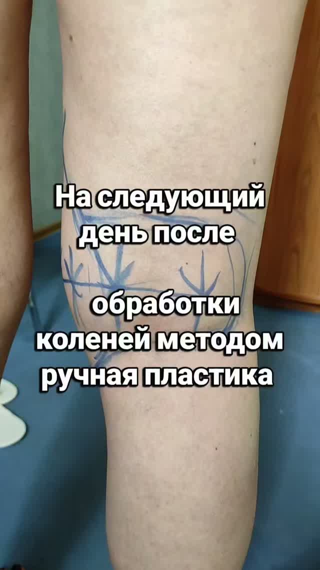 На следующий день, после обработки коленей, методом ручная пластика Newbodyka.