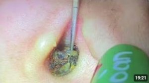КРУПНОЕ УДАЛЕНИЕ СЕРЫ ИЗ УХА