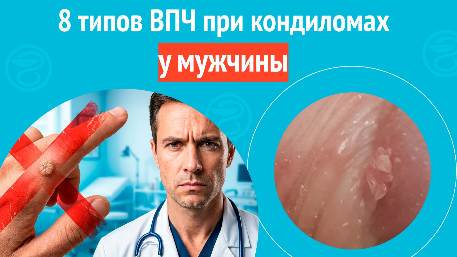 8️⃣ 8 типов ВПЧ при кондиломах у мужчины. Клинический случай №1684 смотреть онлайн