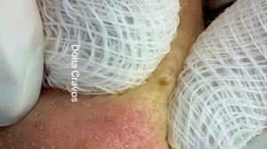 Deep Clean_ Removendo cravos abertos do nariz (blackhead extraction)