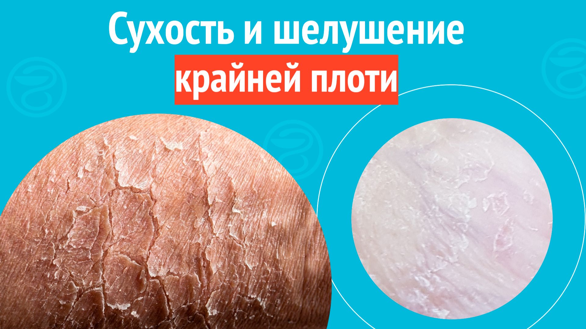 👉 Сухость и шелушение крайней плоти. Клинический случай №1681 смотреть онлайн