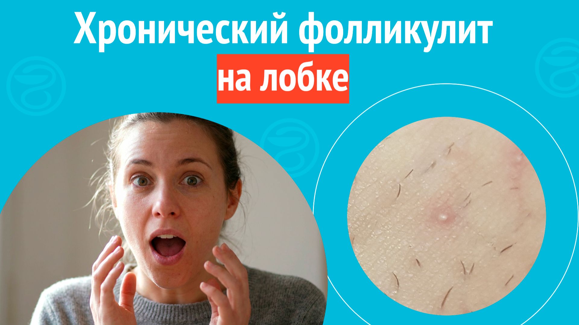 😠 Хронический фолликулит на лобке. Клинический случай №1683 смотреть онлайн