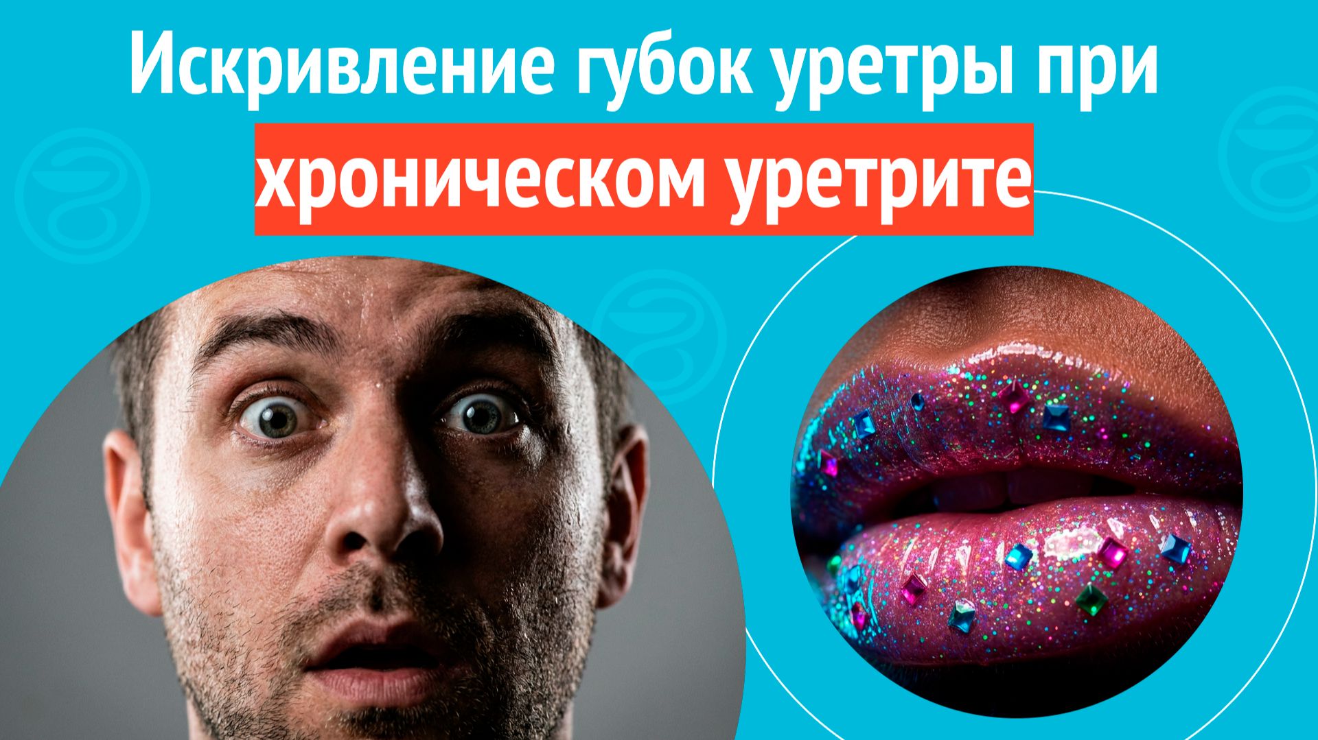 👄 Искривление губок уретры при хроническом уретрите. Клинический случай №1685 смотреть онлайн
