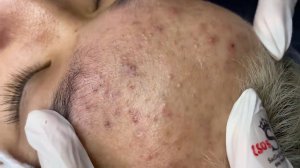 274 • Acne collection • АСМР • Relax Spa