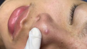 275 • Acne collection • АСМР • Relax Spa