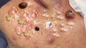 Extreme Blackhead Removal Satisfying Relaxing #978