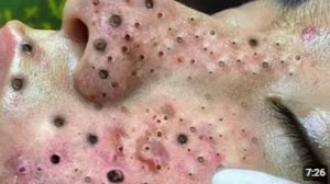 • ВЫДАВЛИВАНИЕ ПРЫЩЕЙ И ЧЁРНЫХ ТОЧЕК — САМЫЙ УДОВЛЕТВОРЯЮЩИЙ РЕЗУЛЬТАТ