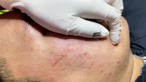 Удаление запущенных закрытых комедонов и белых угрей у мужчины