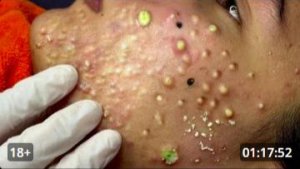 ЧИСТКА ЛИЦА КРУПНЫМ ПЛАНОМ СМОТРИ