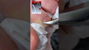 сильные ПРОПИЛЫ — она сделала педикюр себе сама, имея дома аппарат 😬
