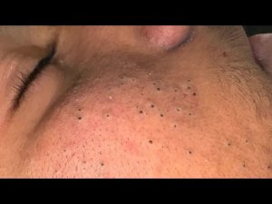 Глубокое очищение пор / Удаление черных точек и уход за кожей |