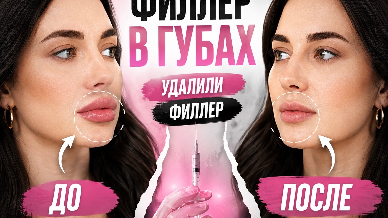 Можно ли филлер в губах удалили до или после