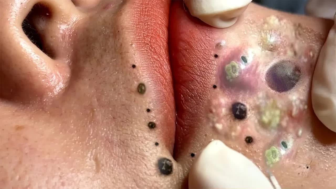 Extreme Blackhead Removal Satisfying Relaxing #977 смотреть онлайн