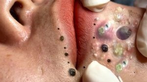 Extreme Blackhead Removal Satisfying Relaxing #977