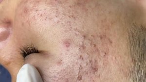 272 • Acne collection • АСМР • Relax Spa