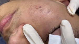 276 • Acne collection • АСМР • Relax Spa