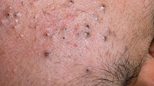 Удаление черных точек и глубокое очищение лица | Корейский уход за кожей